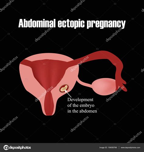 Development Of The Embryo In The Abdomen Ectopic Pregnancy