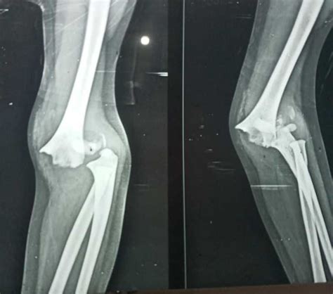 Figure Supracondylar Fracture Contributed By Dr Muhammad Taqi