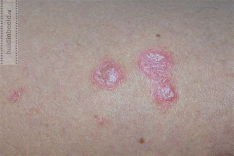 psoriasis vulgaris