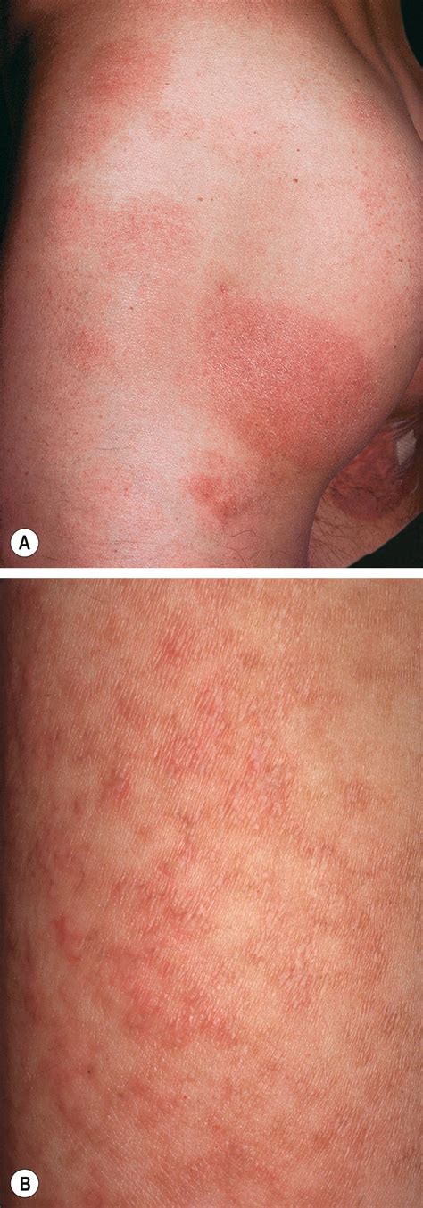 Other Papulosquamous Disorders Clinical Tree