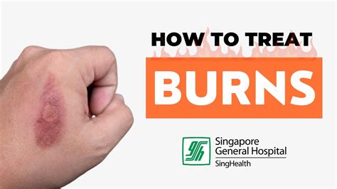 How To Treat Burns My Doctors Advice Youtube