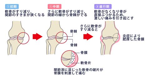 【変形性膝関節症とは】症状や原因、治療法、費用について 日本の名医