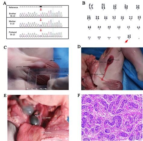 Frontiers 46 XX Testicular Disorders Of Sex Development With DMD Gene