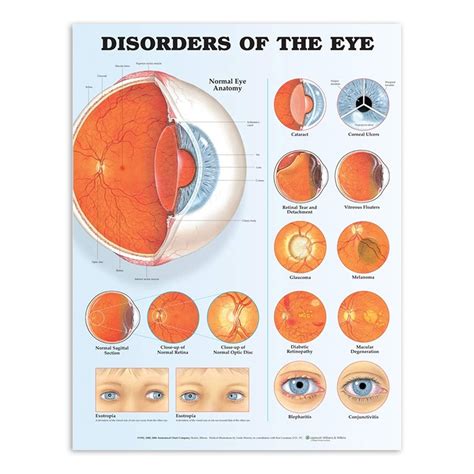 Laminated Chart Disorders Of The Eye Charts And Diagrams Bernell