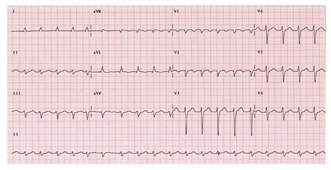 Hypothyroidism Predicts Atrial Tachyarrhythmia After Af Catheter