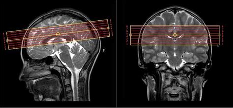 Frontiers Myelin Water Imaging Demonstrates Lower Brain Myelination