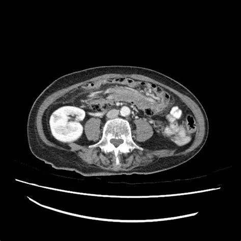 Colo Colonic Intussusception NicholasLack