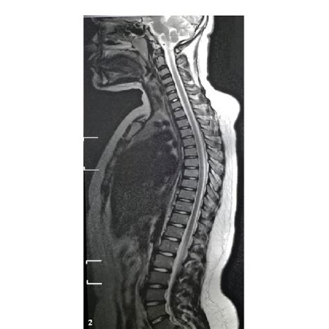 Whole Spine T2 Weighted Magnetic Resonance Imaging With Contrast