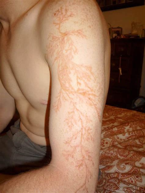 This Is What Happens When Lightning Strikes The Human Body