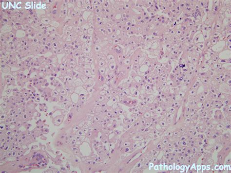 chromophobe rcc pathology