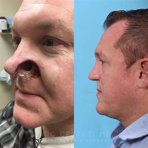 Salt Lake City Ut Facial Reconstructive Surgery Before And After Pictures