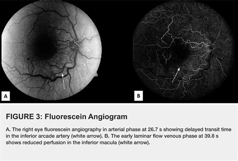 Figure From Combined Central Retinal Vein And Branch Retinal Artery