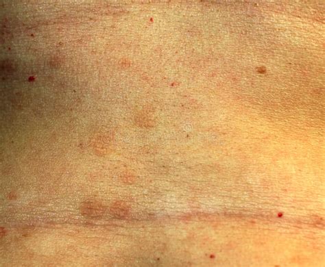 Lichen Planus Rash Stock Photos Free And Royalty Free Stock Photos From