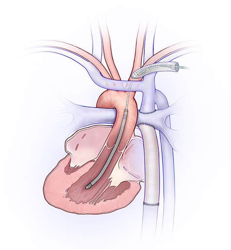 Suprasternal Approach For Implanting A Microaxial Left Ventricular