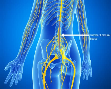 Lumbar Epidural Injection - Ainsworth Institute