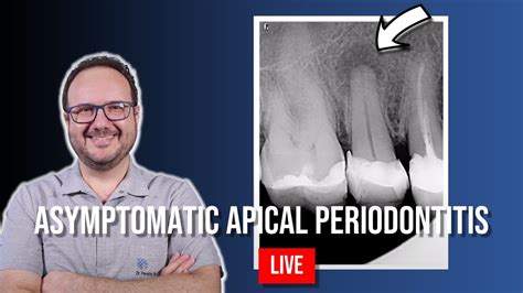 Endo Treatment Of Asyntomatic Apical Periodontitis Of 15 Part 2 Youtube