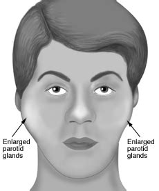 Simplified Approach to Parotid Enlargement | Epomedicine