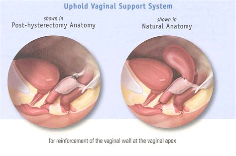 Mesh Grafting For Pelvic Floor Reconstruction Obstetrics And Gynecology Associates Of Hampton