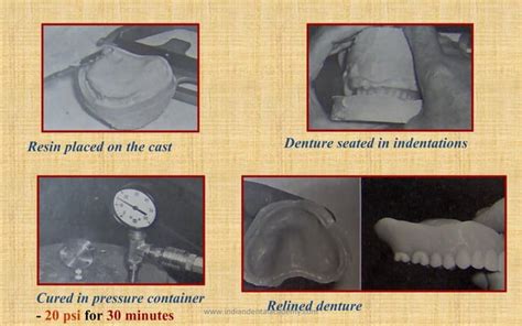 Relining And Rebasing In Complete Dentures Labial Orthodontics