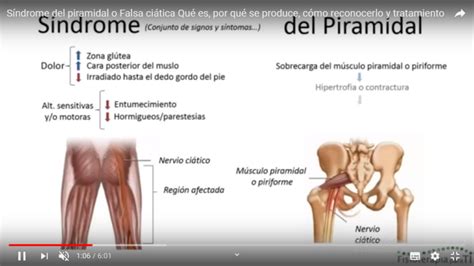 S Ndrome Del Musculo Piramidal O Falsa Ciatica Enriquerubio Net