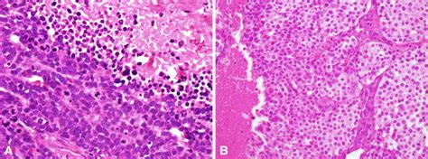 Examples Of Small And Large Cell Salivary Neuroendocrine Carcinomas