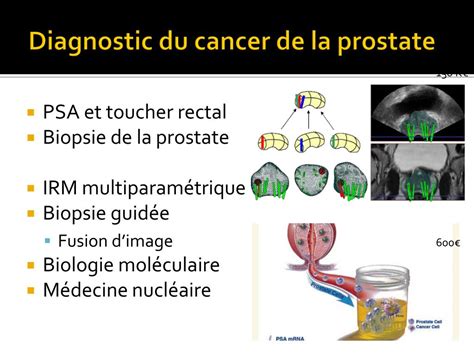 Ppt Parcours Patient Dans Le Cancer Cancer Localis De La Prostate