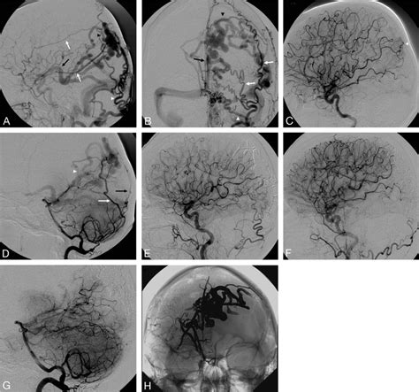 A Right External Carotid Angiography Lateral View B Left External Download Scientific