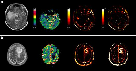 Representative Mr Images With Perfusion And T Weighted Images Of An