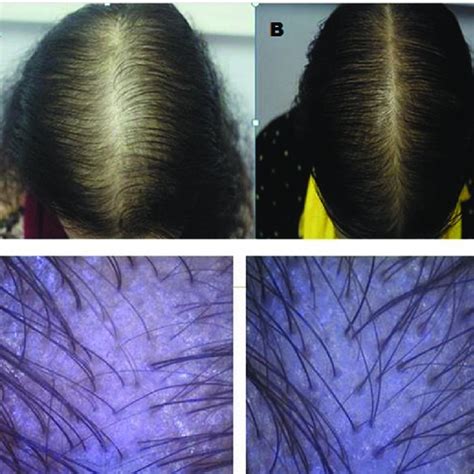 A 46 Year Old Woman With Androgenetic Alopecia Before And 3 Months