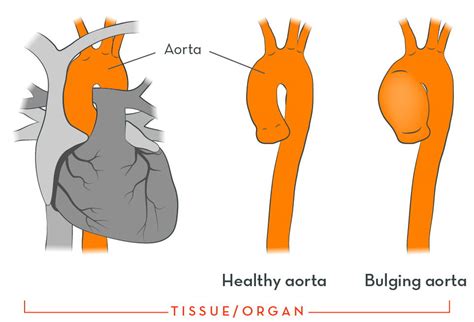 Marfan Syndrome Aorta