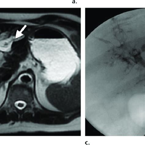 Anastomotic Stricture A Percutaneous Transhepatic Cholangiogram