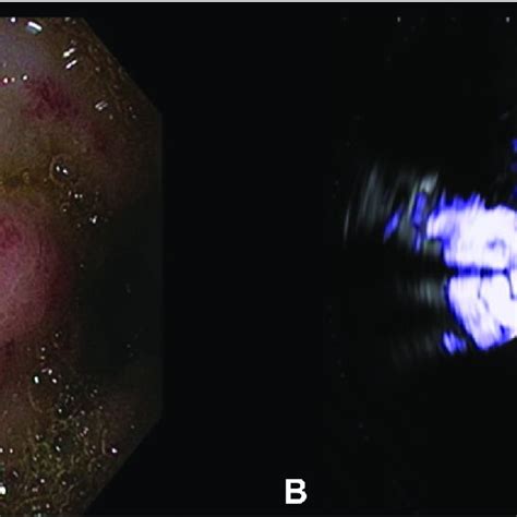 A Eus Showing Positive Doppler Signal B Egd Showing Large Blebs With