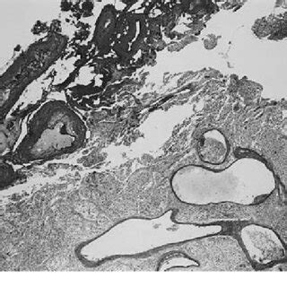 Photomicrograph Of The Surgical Specimen Removed From The Left Medial