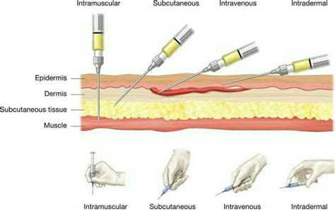 Subcutaneous Injection Angle Best Price | ricardoalpoim.com.br