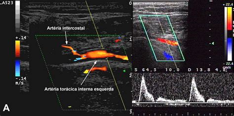 A Ecocardiografia Em Casos Especiais Parte 5 Blog Ecope