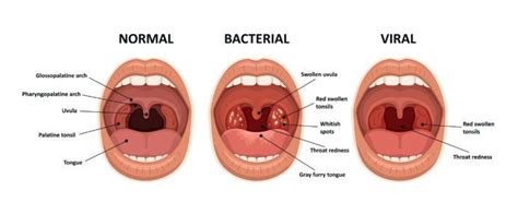 Sore Throat Vs. Strep Throat: What's The Difference? - ActiveBeat ...