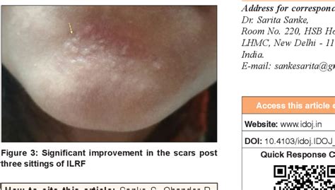 Figure 2 from Intralesional Radiofrequency for Papular Acne Scars | Semantic Scholar