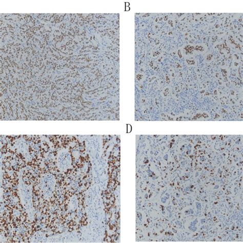 Sp Immunohistochemical Detection Of Ar And Ki In Primary Invasive