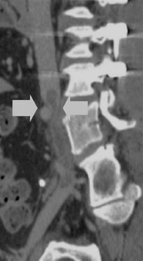 Ct Venogram Shows Compression Of Left Common Iliac Vein By Right Common