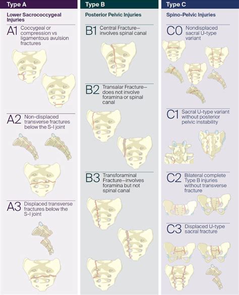 Inter And Intra Observer Agreement Using The New Aospine Sacral