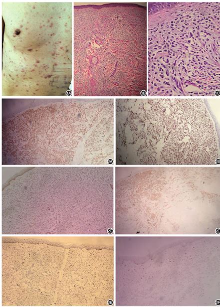 Initial Presentation Of Acute Myeloid Leukemia In A Patient With