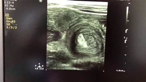 Intussusception Youtube