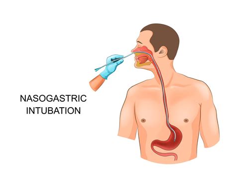 Sonda Nasog Strica E Nasoenteral Qual A Diferen A
