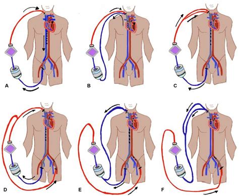 Technical Considerations For Percutaneous Pulmonary Artery Cannulation