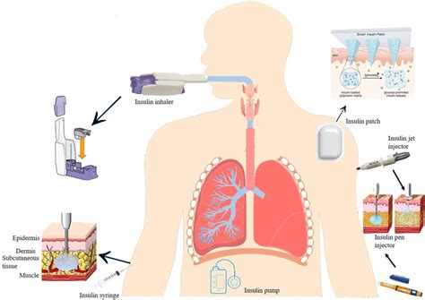 Schematic Illustration Of Various Insulin Administration Routes The