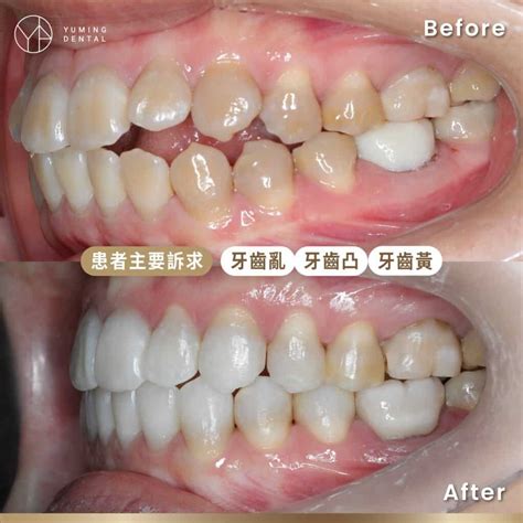 隱適美矯正案例分享｜開咬－祐民牙醫 楊大為醫師74 Invisalign Case 祐民牙醫