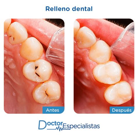 Dentistas Recomendados Para Rellenos Dentales Doctor Especialistas