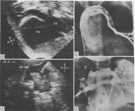 Cross Sectionl Echocardiograms A And B Showing Mixed Total