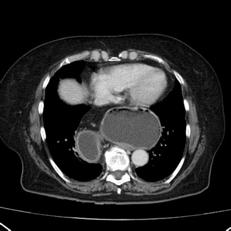 Radiopaedia case Paraesophageal hiatal hernia id: 26979 study: 27157 ...