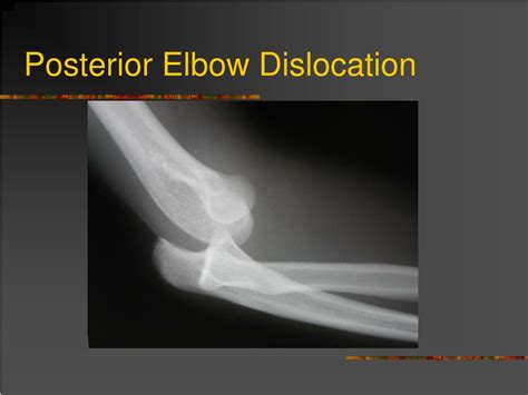 Ppt Dislocation And Fracture Reductions Powerpoint Presentation Free